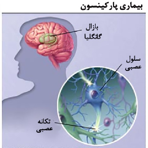 بیماری پارکینسون (Parkinson) 59 اسلاید ppt